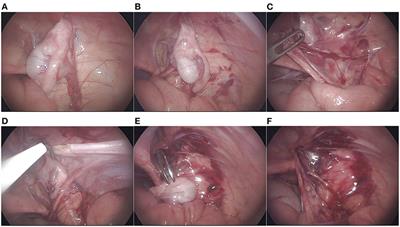Clinical Efficacy of Laparoscopic Orchiopexy With the Modified Prentiss Maneuver for Non-palpable Testis Near the Internal Ring
